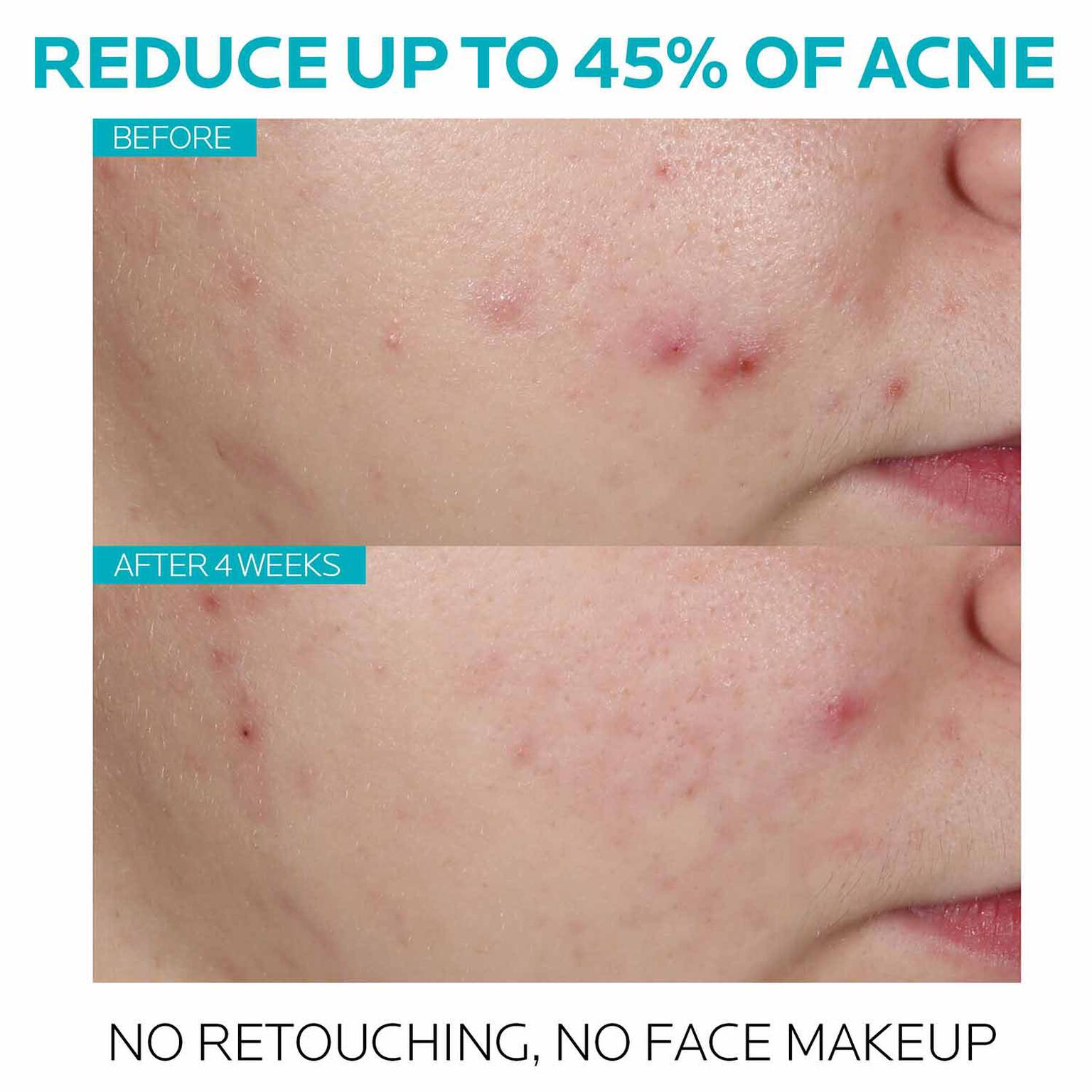 effaclar-salicylic-acid-acne-treatment-serum-k4 7_EffaclarSerum_After-45-days.jpg